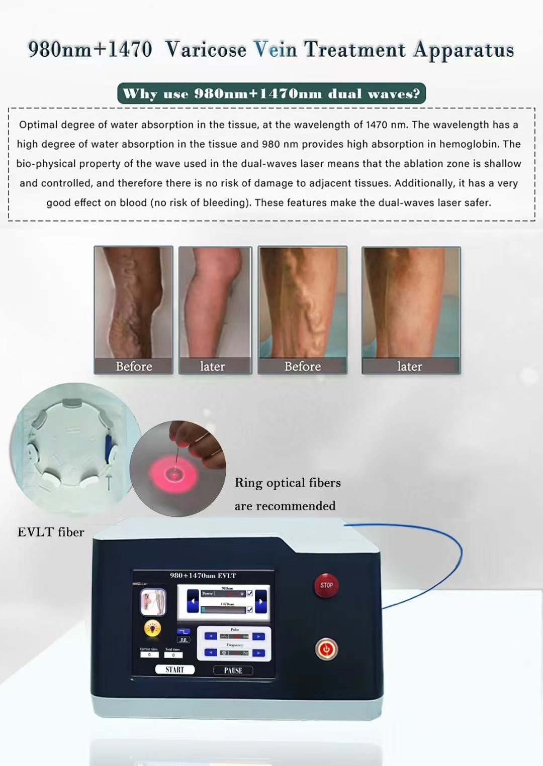 980nm 1470Nm Çift Dalgaboyu Diyot Lazer Endolift Lazer Makinesi 6 1 - Görsel 3