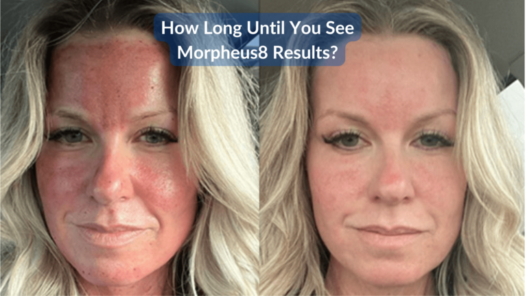Morpheus8 Sonuçlarını Ne Kadar Zamanda Göreceksiniz?