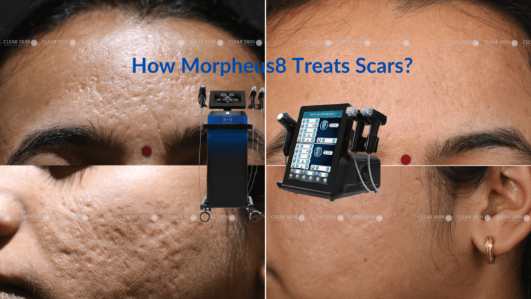 Morpheus8 Yara İzlerini Nasıl Tedavi Ediyor Etkili Çözümler ve Dönüştürücü Sonuçlar (1)