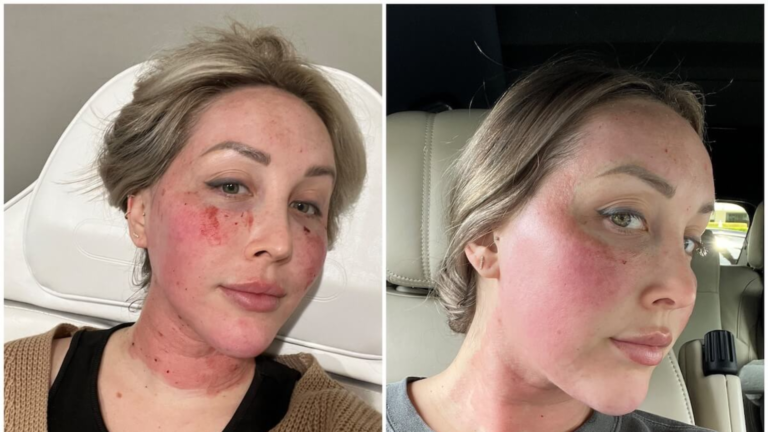 Morpheus8 öncesi ve sonra