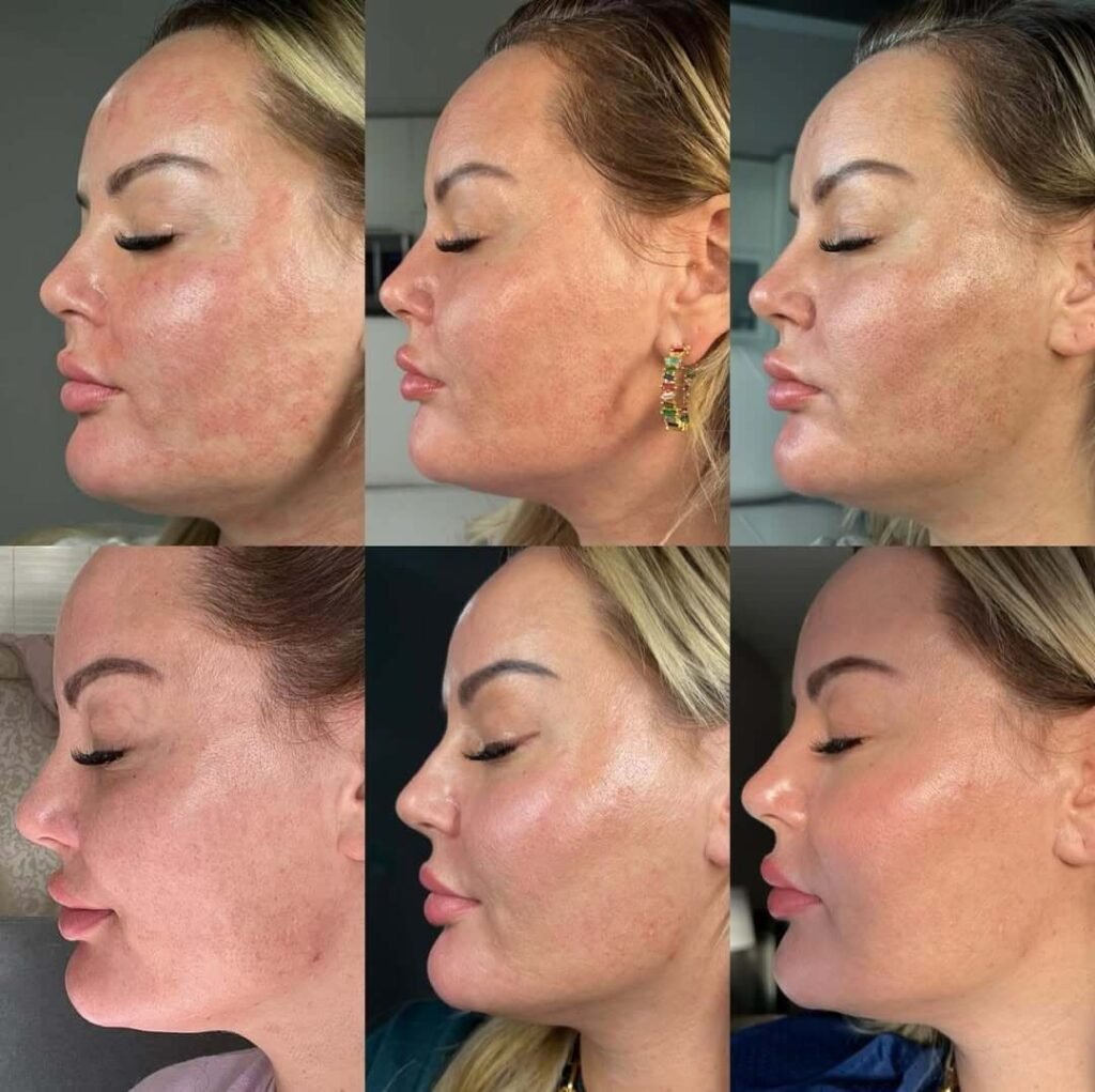 7 days after morpheus treatment