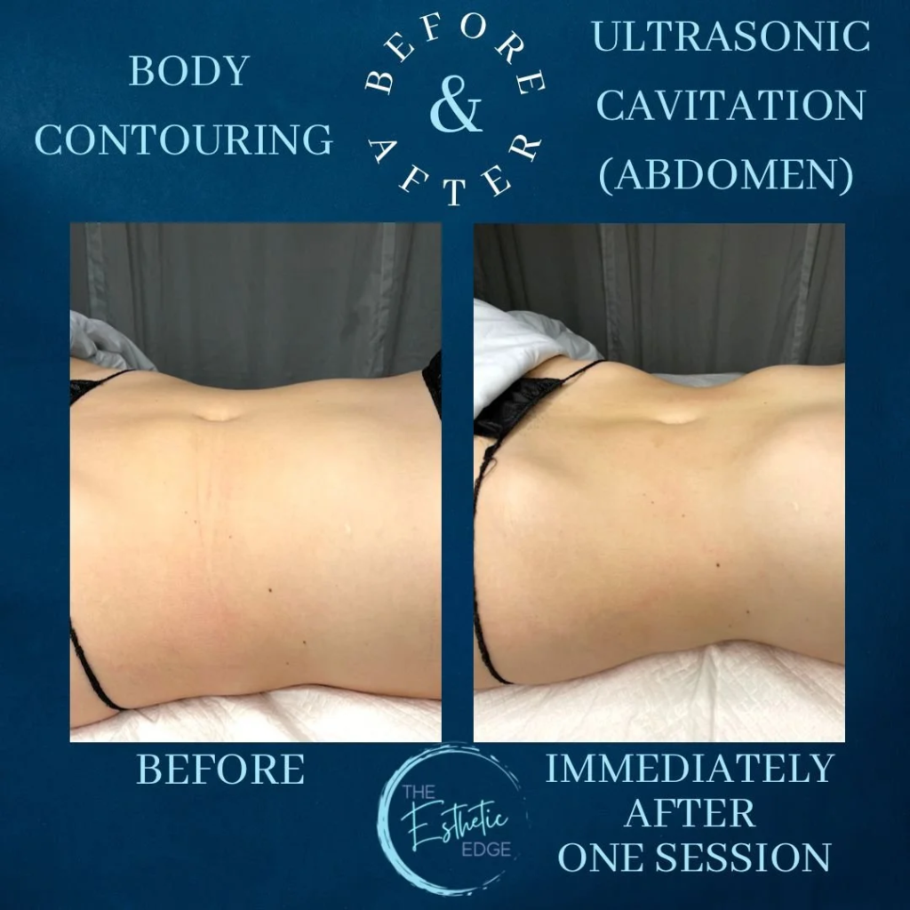 contorno corporal-cavitación-ultrasónica-abdomen antes y después