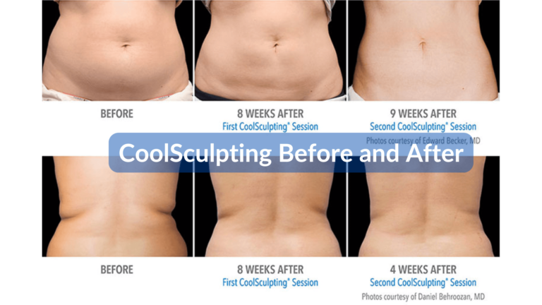 CoolSculpting avant et après