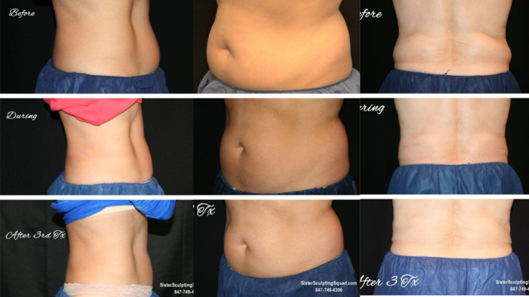 CoolSculpting Avant et Après (3)