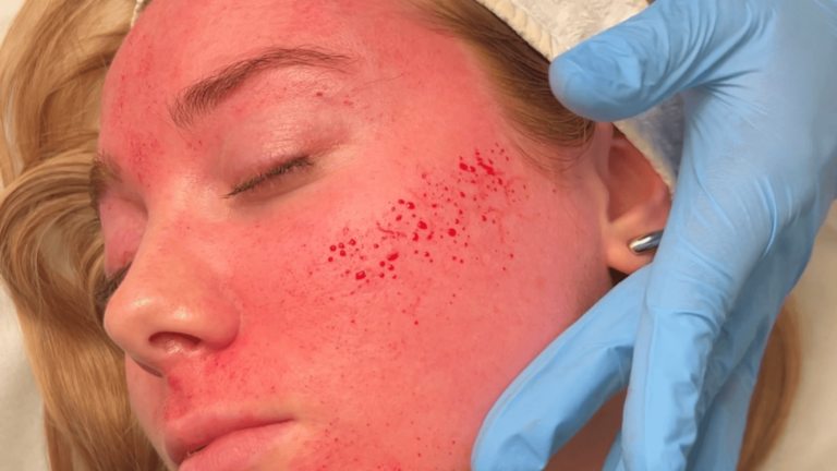 Does Microneedling Hurt (1)