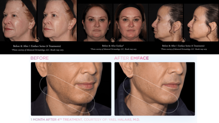EMFACE Before and After (1)