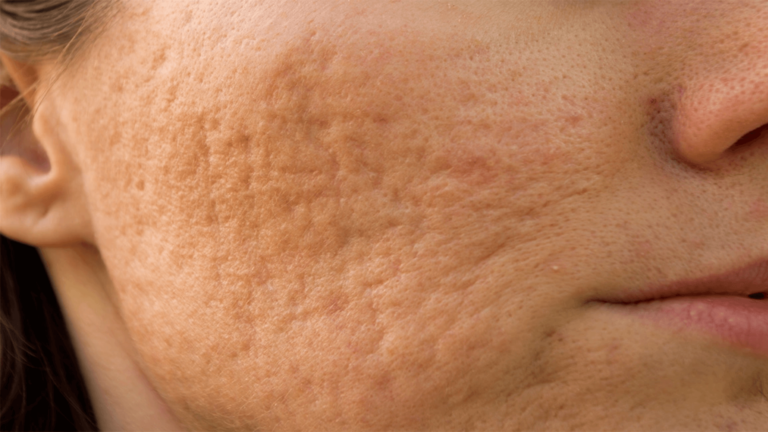 Is Morpheus8 Effective for Treating Deep Rolling Scars (1)