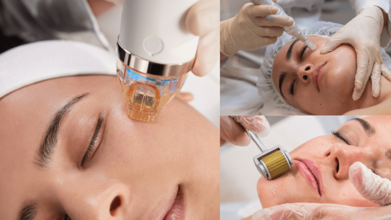 Microneedling Before and After One Treatment Smooth, Radiant Skin Results (1)