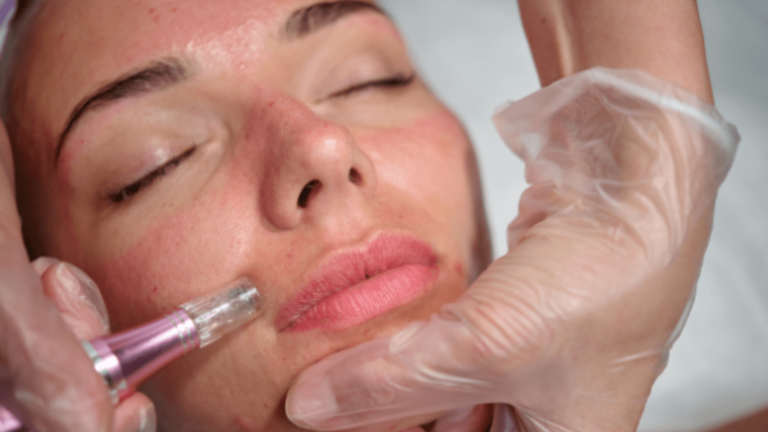 Microneedling Downtime (1)