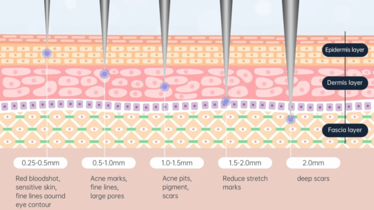 The Ideal Microneedling Depth for Deep Acne Scars (1)