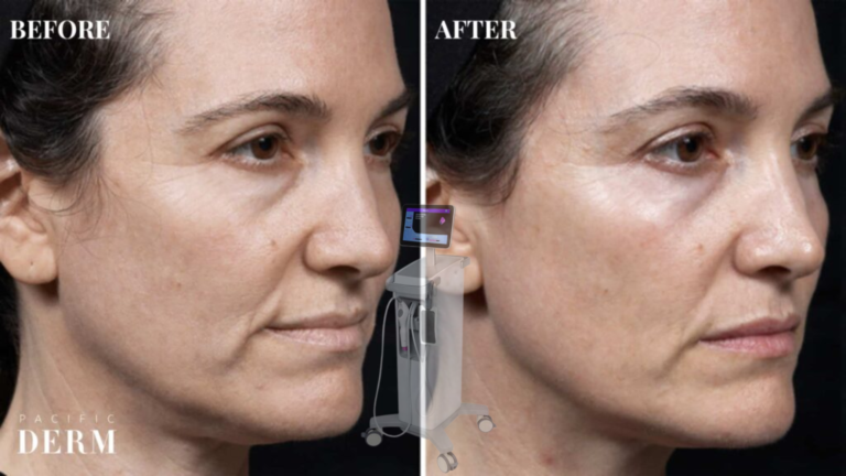Thermage Before and After
