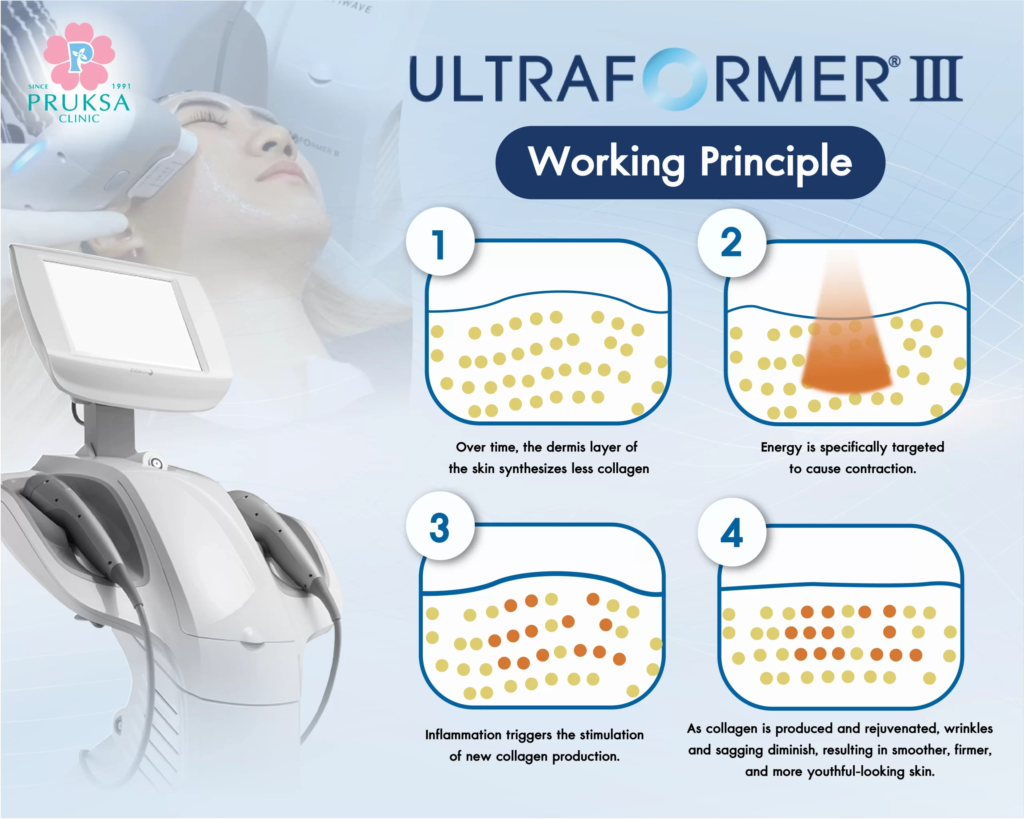 Cómo funciona Ultraformer 3