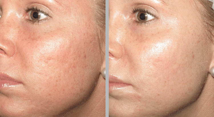 Microneedling treat for uneven texture of skin 
