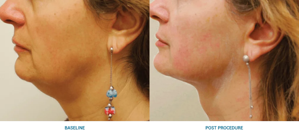 Ultraformer 3 antes y después del cuello