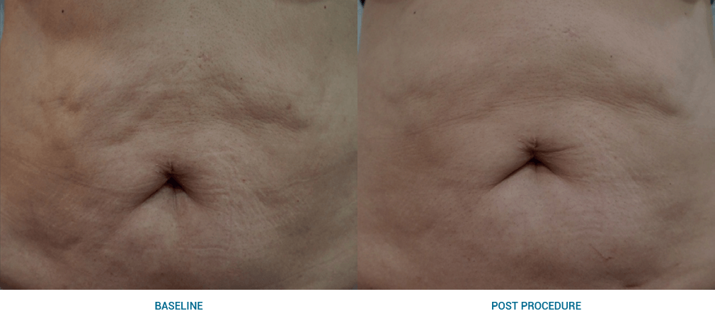 Ultraformer 3 antes y después del abdomen