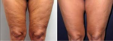 Ultraformer 3 antes y después de los muslos