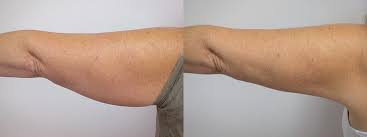 Ultraformer 3 antes y después del brazo