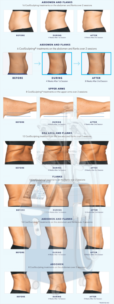 CoolSculpting før og efter