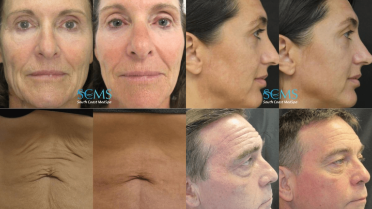 How-Long-Does-It-Take-to-See-Results-from-Morpheus8