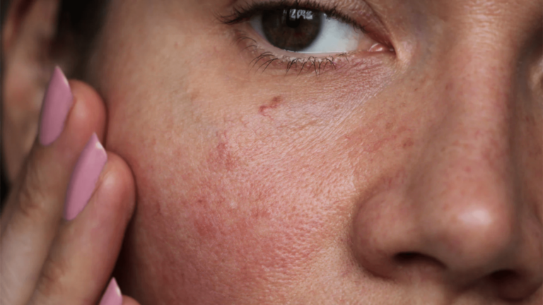 HydraFacial for Sensitive Skin Is It Suitable?