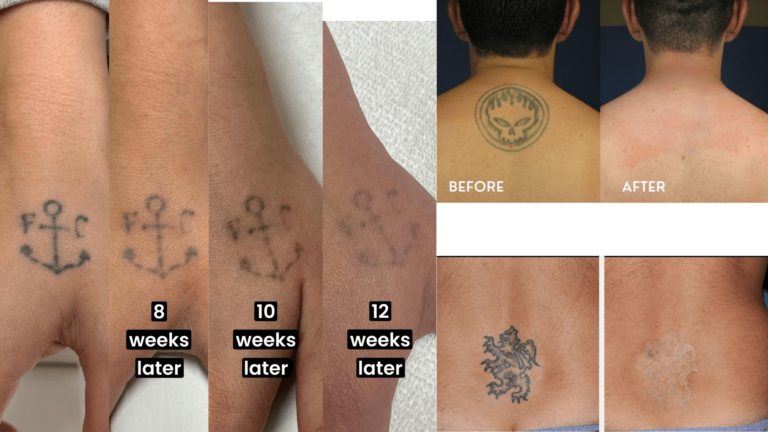 Détatouage au laser avant et après (1)