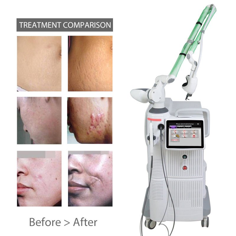 aplicações de máquinas a laser fotona 4d