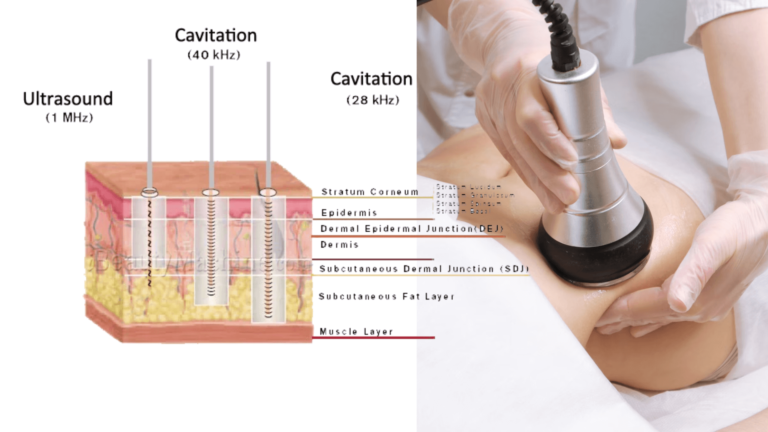 Meilleure fréquence pour la cavitation ultrasonique