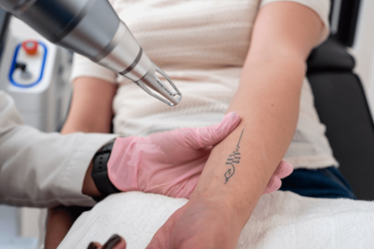 How Much Laser Tattoo Removal Cost?