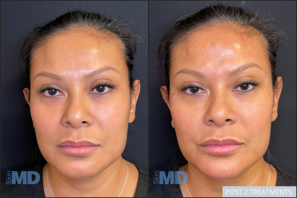 Morpheus8 4 to 6 Weeks