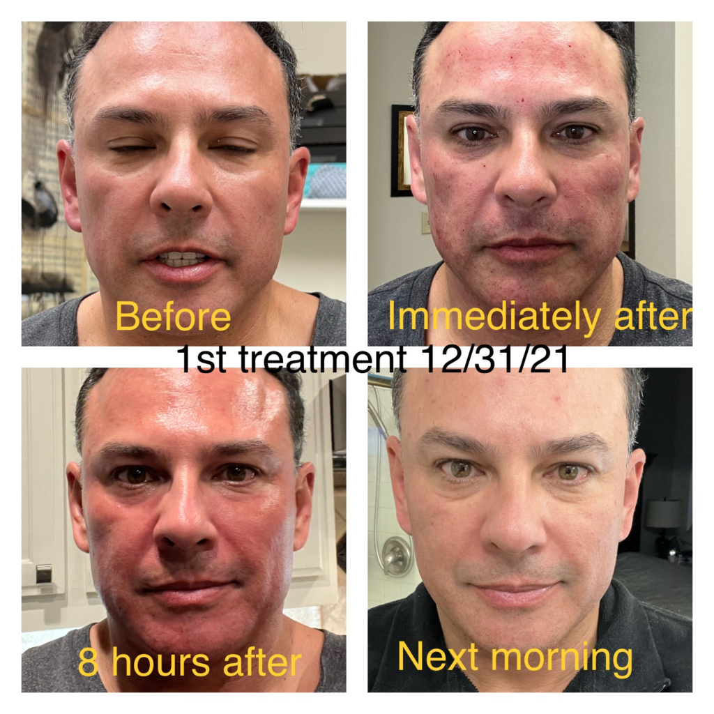 Morpheus8 1 to 2 Weeks