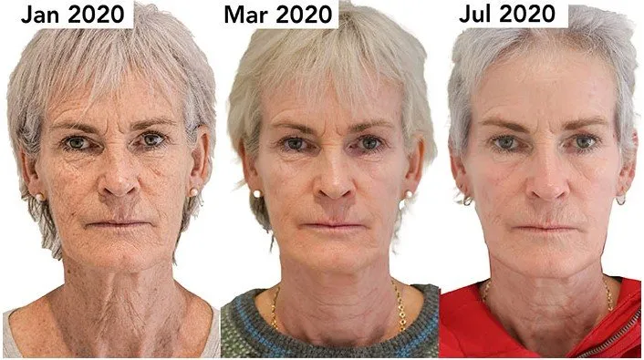 Morpheus8 3 to 6 month