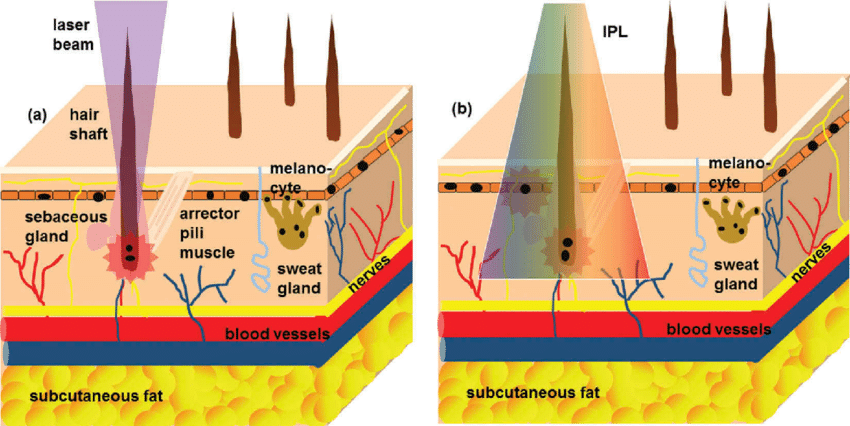 laser vs IPL for hair removal