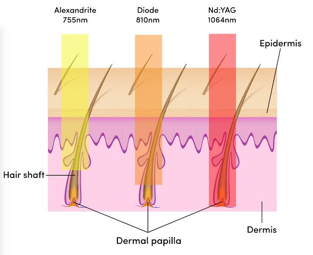 Diode vs. Alexandrite vs. IPL