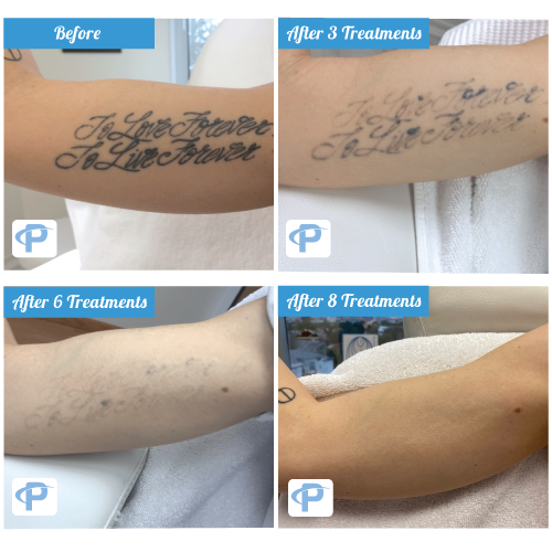 Laser Tattoo Removal Before and After