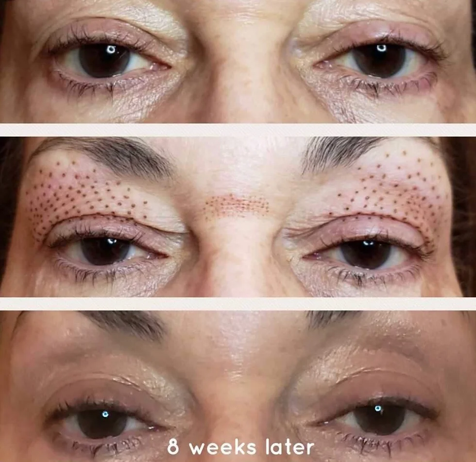 Plasma Pen Eye Lift before and after