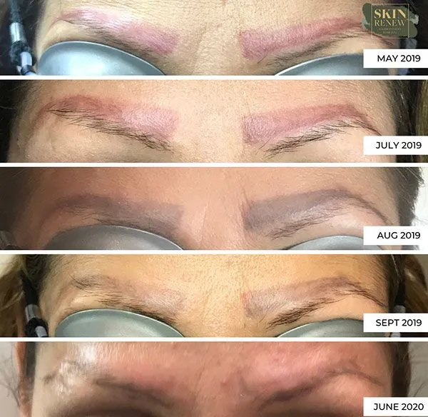 eyebrow tattoo removal