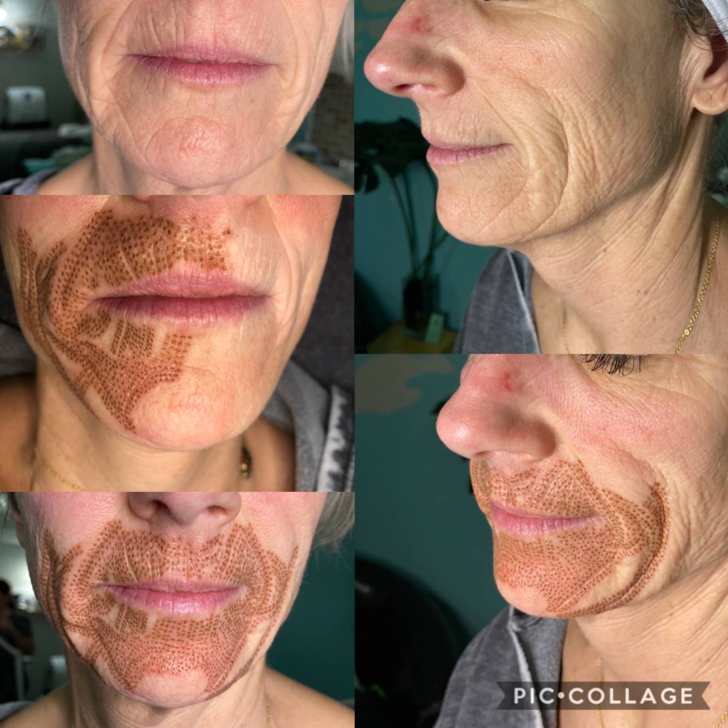 Plasma Pen Skin Tightening before and after