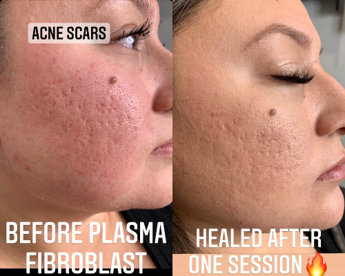 Plasma Pen for Acne Scarring