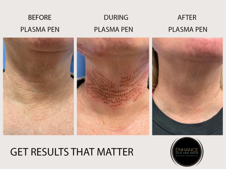 Plasma Pen for Chin & Neck Area