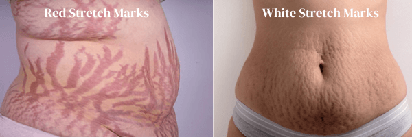 Rote-Dehnungsstreifen-VS-Weiße-Dehnungsstreifen