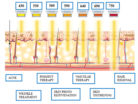 Allgemeine Anwendungen von IPL-Geräten