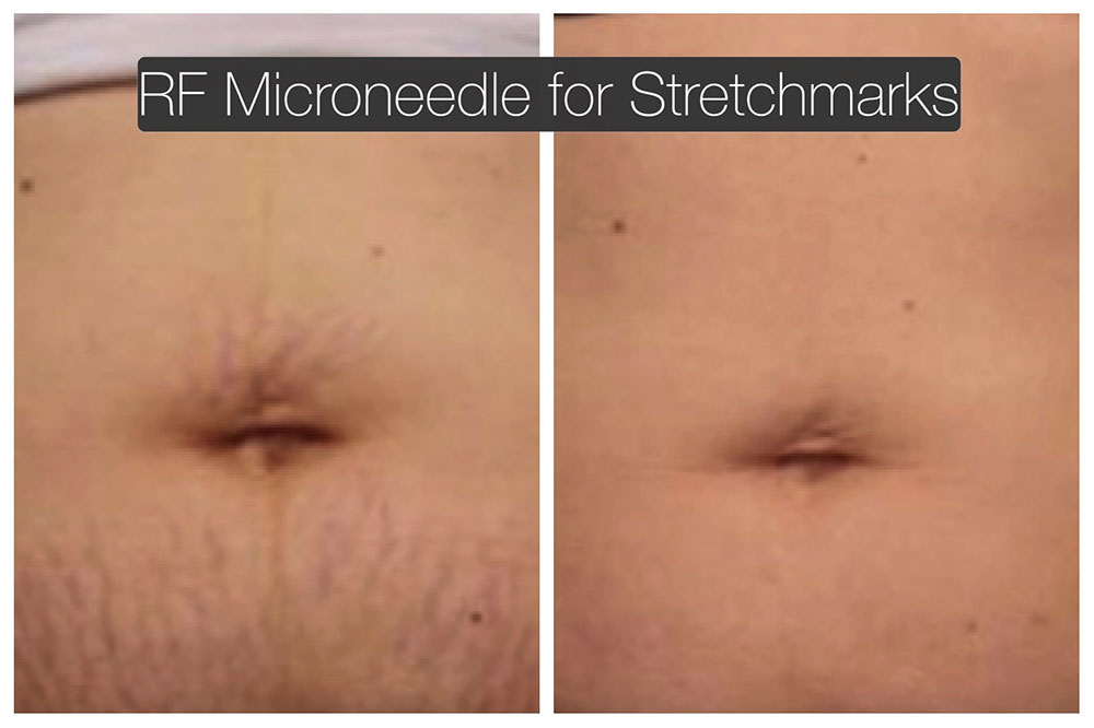 RF microneedle for stretchmarks