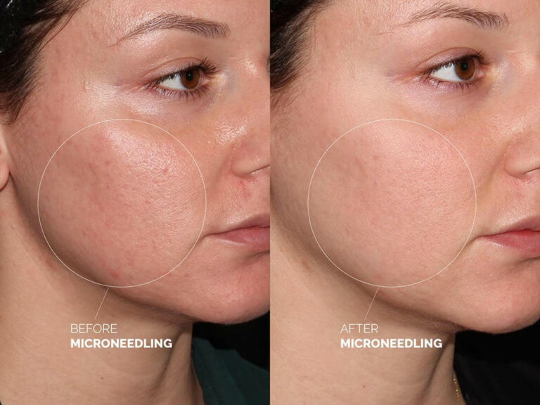 microneedling for acne scars
