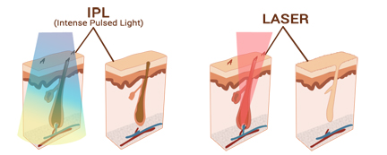 IPL VS Laser, wie es funktioniert