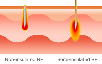 Insulated vs. Non-Insulated Needles