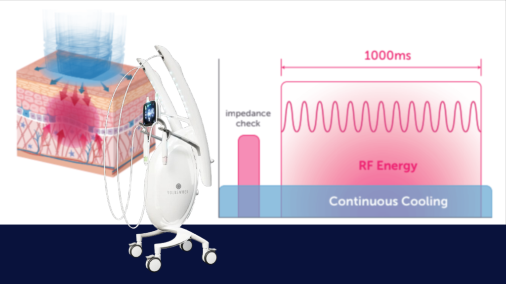 100 preguntas sobre Thermage (1)