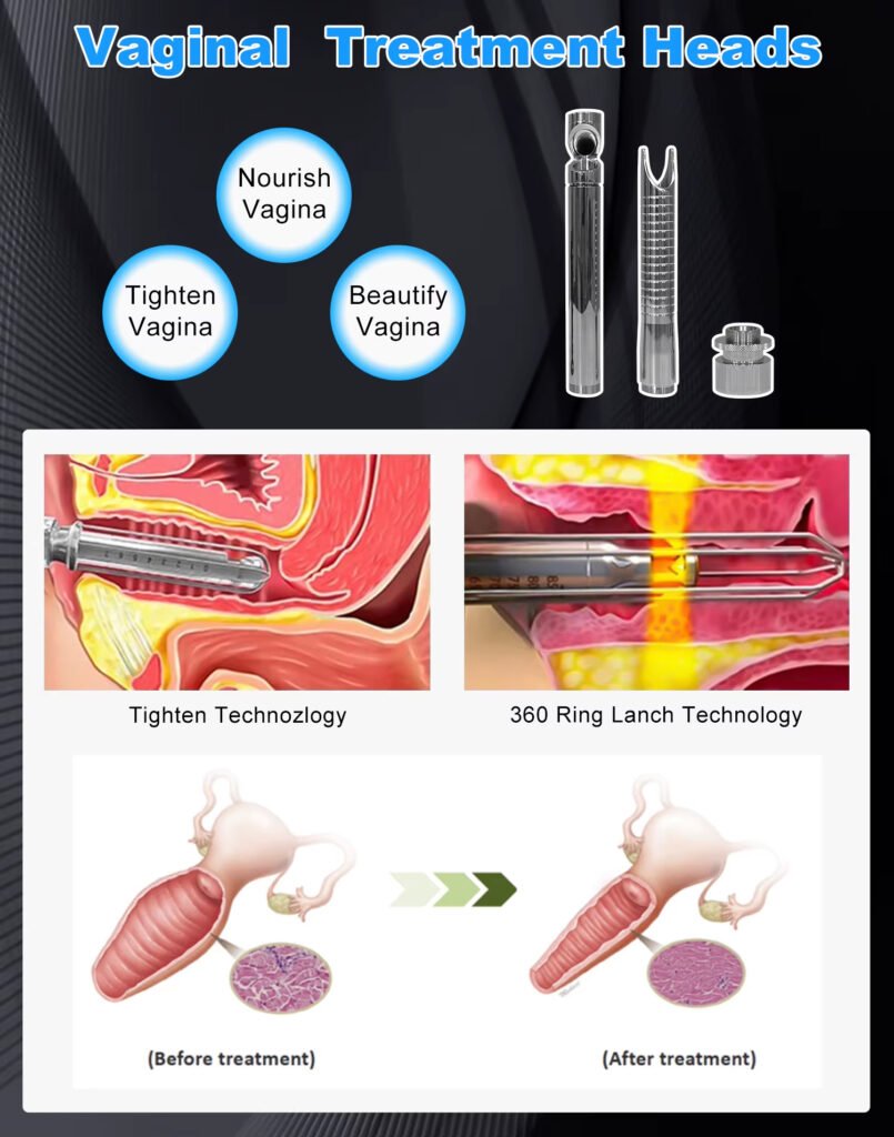 Perawatan vagina kepala mesin laser CO2
