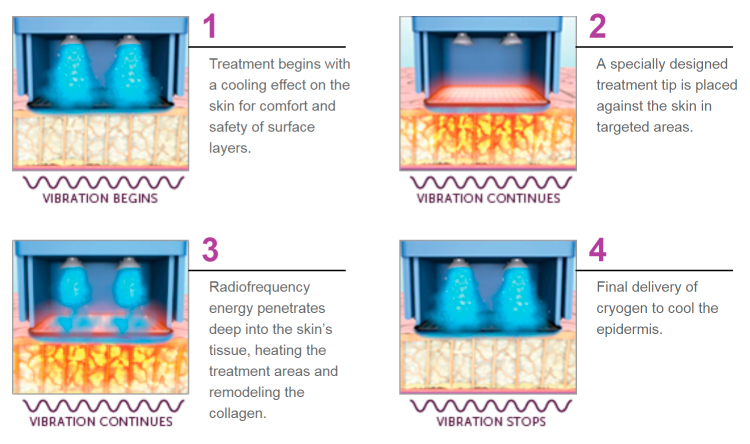 how does thermage works