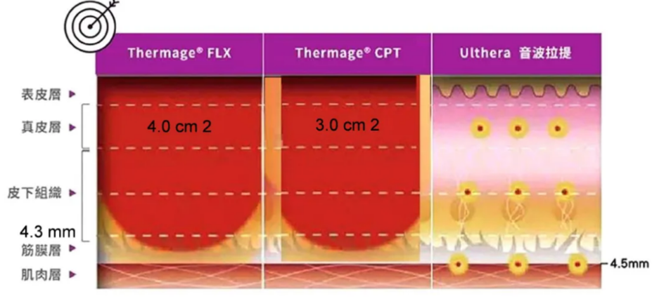 thermage can function on the SMAS layer