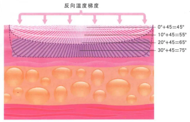 The Reverse Thermal Gradient of Thermage